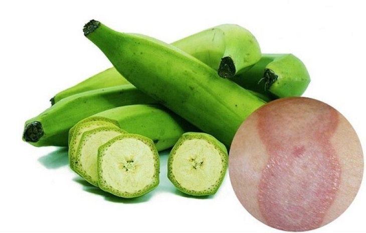 Chuối xanh trị hắc lào