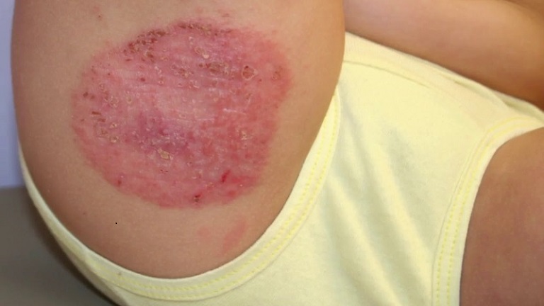 Top 10 Cách Chữa Hắc Lào Ở Háng Tại Nhà Hiệu Quả Nhất 2025