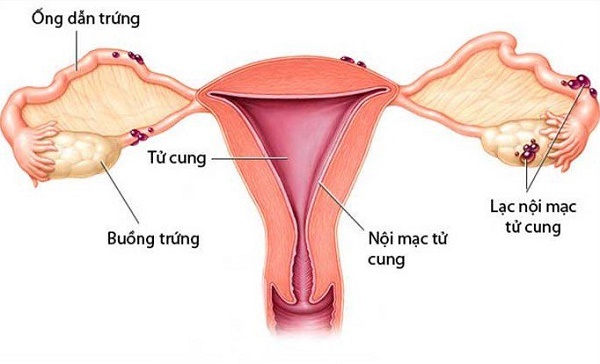 Lạc nội mạc tử cung là nguyên nhân dẫn đến đau bụng kinh nặng