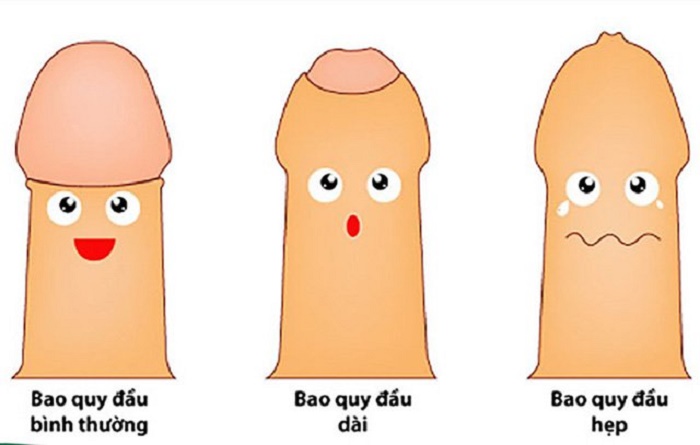 hẹp bao quy đầu