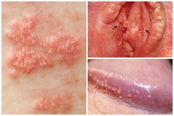 Blue Waffle Là Gì? Những Hình Ảnh Về Căn Bệnh Nguy Hiểm Này