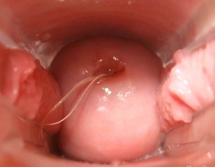 Blue Waffle Là Gì? Những Hình Ảnh Về Căn Bệnh Nguy Hiểm Này