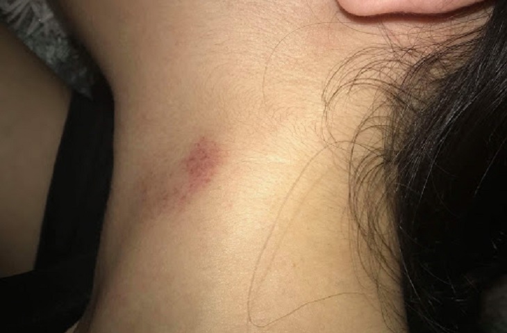 Hickey Là Gì? Hickey Có Nguy Hiểm Không? Cách Tạo Hickey